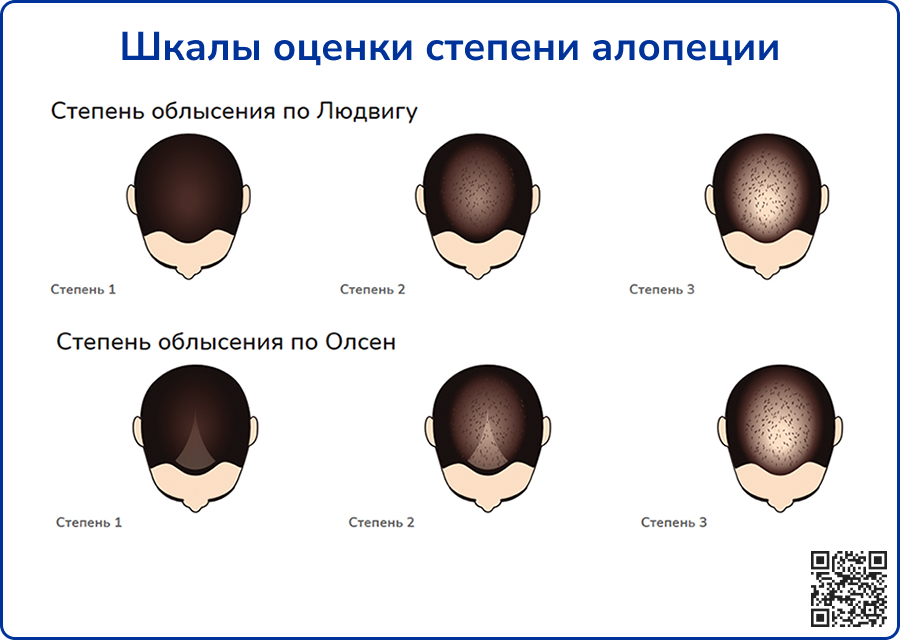Шкалы оценки степени алопеции
